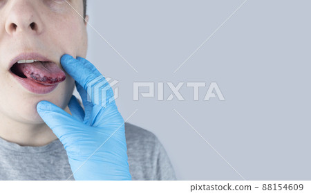 Black tongue. A man shows the consequences of an injury, bite or burn of the tongue. Part is damaged. Treatment of internal injuries Black tongue. A man shows the consequences of an injury, bite or burn of the tongue. Part is damaged. Treatment of internal injuries 88154609