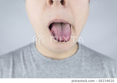 Black tongue. A man shows the consequences of an injury, bite or burn of the tongue. Part is damaged. Treatment of internal injuries Black tongue. A man shows the consequences of an injury, bite or burn of the tongue. Part is damaged. Treatment of internal injuries 88154610