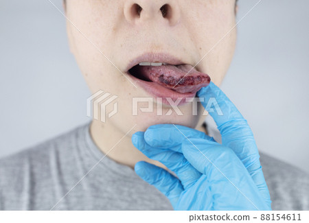 Black tongue. A man shows the consequences of an injury, bite or burn of the tongue. Part is damaged. Treatment of internal injuries Black tongue. A man shows the consequences of an injury, bite or burn of the tongue. Part is damaged. Treatment of internal injuries 88154611