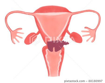 Stage and progression of cervical cancer (stage IIB) Stage and progression of cervical cancer (stage IIB) 88180997