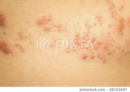 帶狀皰疹圖片 88181687