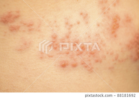 Shingles image Shingles image 88181692