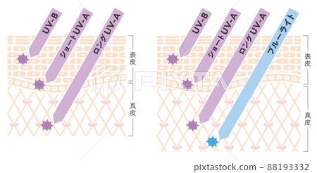 Skin diagram of skin damage caused by light 88193332