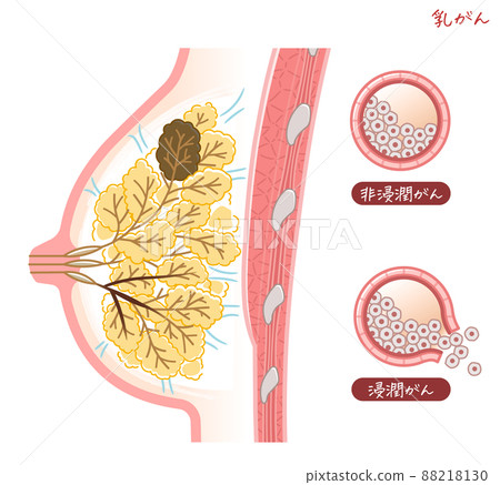Illustration of breast cancer, breast cancer, breast cancer, Breast cancer Illustration of breast cancer, breast cancer, breast cancer, Breast cancer 88218130