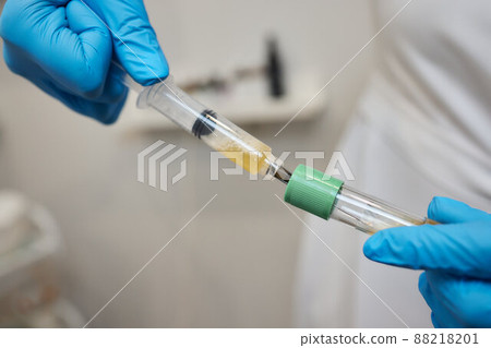 Beautician doctor's hands put test tube with blood in centrifuge container. Rejuvenation plasmolifting procedure. Beautician doctor's hands put test tube with blood in centrifuge container. Rejuvenation plasmolifting procedure. 88218201