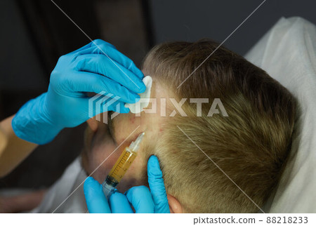 Injection at spa salon. Doctor hands in gloves. Closeup. Pretty male patient. Beauty treatment. Healthy skin procedure. Young man face. Plasmolifting rejuvenation. 88218233