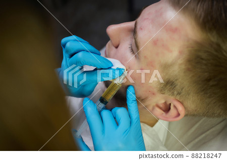 Injection at spa salon. Doctor hands in gloves. Closeup. Pretty male patient. Beauty treatment. Healthy skin procedure. Young man face. Plasmolifting rejuvenation. Injection at spa salon. Doctor hands in gloves. Closeup. Pretty male patient. Beauty treatment. Healthy skin procedure. Young man face. Plasmolifting rejuvenation. 88218247