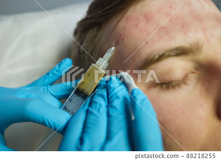 Injection at spa salon. Doctor hands in gloves. Closeup. Pretty male patient. Beauty treatment. Healthy skin procedure. Young man face. Plasmolifting rejuvenation. 88218255