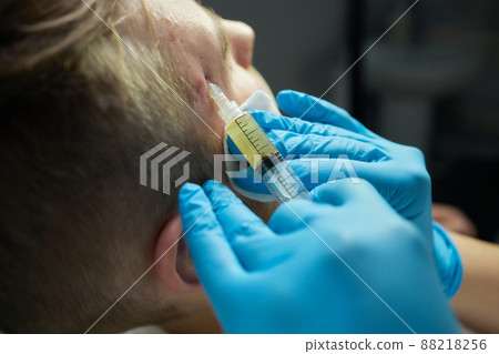 Injection at spa salon. Doctor hands in gloves. Closeup. Pretty male patient. Beauty treatment. Healthy skin procedure. Young man face. Plasmolifting rejuvenation. Injection at spa salon. Doctor hands in gloves. Closeup. Pretty male patient. Beauty treatment. Healthy skin procedure. Young man face. Plasmolifting rejuvenation. 88218256