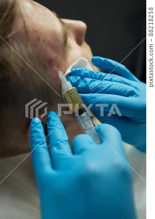 Injection at spa salon. Doctor hands in gloves. Closeup. Pretty male patient. Beauty treatment. Healthy skin procedure. Young man face. Plasmolifting rejuvenation. 88218258