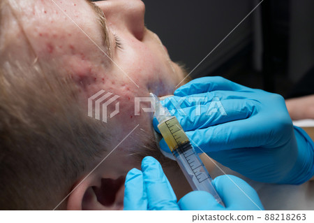 Injection at spa salon. Doctor hands in gloves. Closeup. Pretty male patient. Beauty treatment. Healthy skin procedure. Young man face. Plasmolifting rejuvenation. 88218263