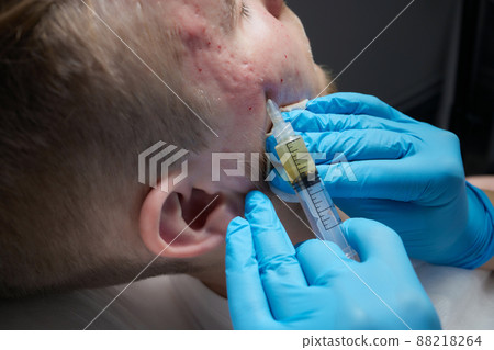 Injection at spa salon. Doctor hands in gloves. Closeup. Pretty male patient. Beauty treatment. Healthy skin procedure. Young man face. Plasmolifting rejuvenation. 88218264