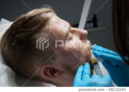 Injection at spa salon. Doctor hands in gloves. Closeup. Pretty male patient. Beauty treatment. Healthy skin procedure. Young man face. Plasmolifting rejuvenation. Injection at spa salon. Doctor hands in gloves. Closeup. Pretty male patient. Beauty treatment. Healthy skin procedure. Young man face. Plasmolifting rejuvenation. 88218265