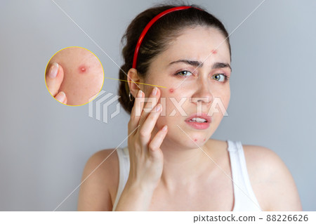 A young pretty brunette looks at her face with pimples. The concept of cosmetology and acne control, adolescence. Enlarged image 88226626