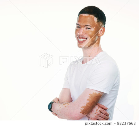 My skin doesnt define me. Portrait shot of a handsome young man with vitiligo posing with his arms folded on a white background. 88237668