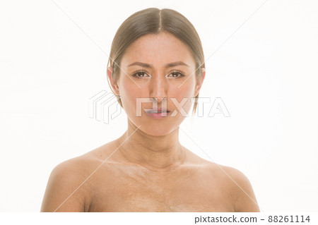 Latin honduras female with scleroderma autoimmune skin disease. Body positive unaltered skincare 88261114