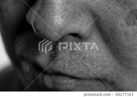 Dirt on the nose, darkening of pores, keratin plug substance 88277161