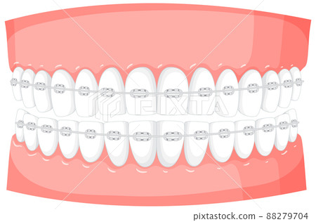 Braces on a model of human teeth - Stock Illustration [88279704] - PIXTA