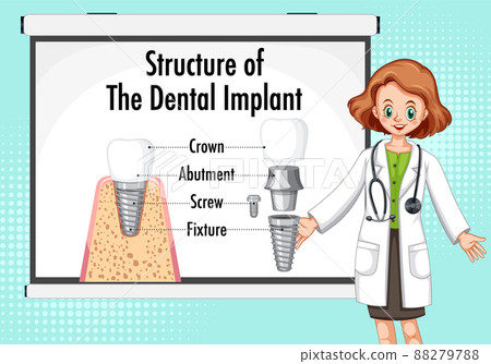 Infographic of human in structure of the dental implant Infographic of human in structure of the dental implant 88279788