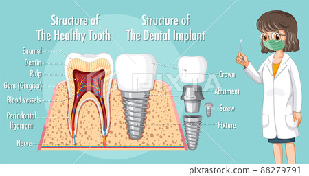 Infographic of human in structure of the dental implant Infographic of human in structure of the dental implant 88279791