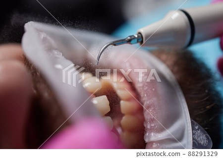 Macro photography. Top view on cleaning process in patient's mouth. Cleaning teeth with water jet and saliva ejector. Cheek retractor on the mouth. Concept of professional dental hygiene. Macro photography. Top view on cleaning process in patient's mouth. Cleaning teeth with water jet and saliva ejector. Cheek retractor on the mouth. Concept of professional dental hygiene. 88291329