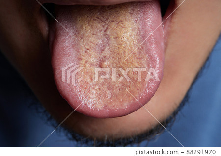 tongue with ulcers of adult man.Cracks in the tongue of a young man.man with halitosis for candida albicans on tongue. tongue with ulcers of adult man.Cracks in the tongue of a young man.man with halitosis for candida albicans on tongue. 88291970