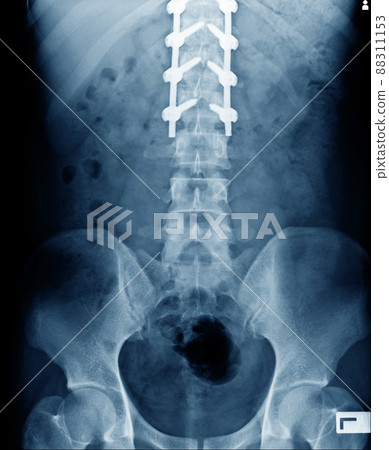 anterior view of structure bone with internal fixation anterior view of structure bone with internal fixation 88311153