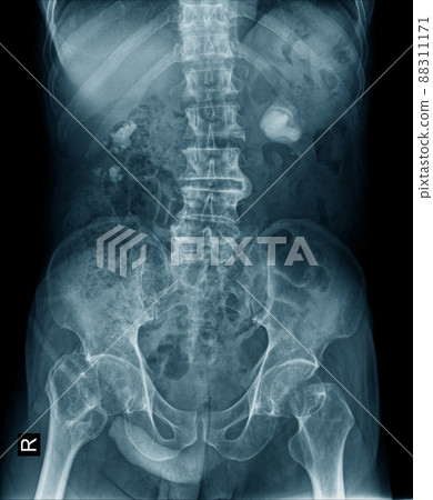 Renal calculus or kidney stone x-ray image in blue tone Renal calculus or kidney stone x-ray image in blue tone 88311171