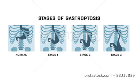 Stages of gastroptosis. Dropped stomach. Shapes and positions of the stomach 88333889