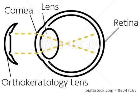Illustration of vision correction lens and orthokeratology lens (before wearing) Illustration of vision correction lens and orthokeratology lens (before wearing) 88347163