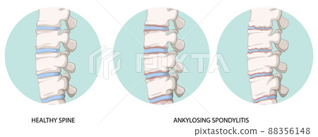 Infographic of healthy spine and ankylosing spondylitis 88356148