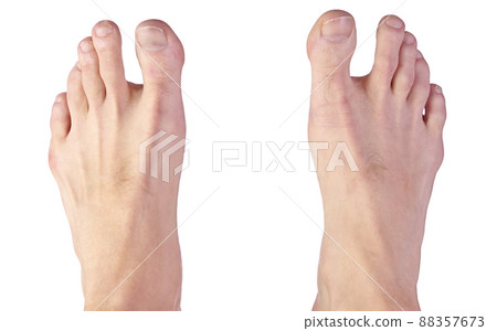 Close up of a Man's Feet Showing Sandal Gap Deformity, also known as Hallux Varus 88357673