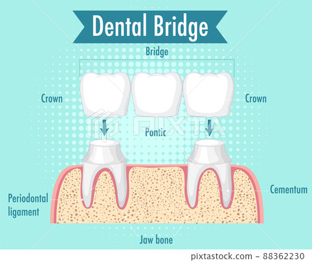 Infographic of human in dental bridge Infographic of human in dental bridge 88362230