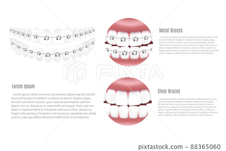 Banner or poster for dentistry with dental braces realistic vector illustration. 88365060