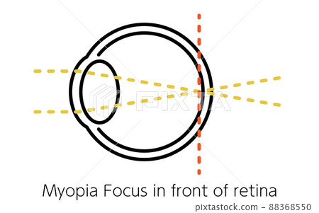 Medical illustration of visual acuity and refractive error, emmetropia (focused on retina) Medical illustration of visual acuity and refractive error, emmetropia (focused on retina) 88368550