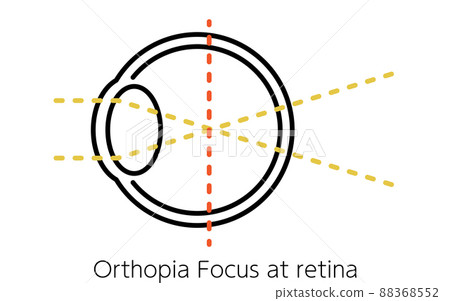 Medical illustrations of visual acuity and refractive error, myopia (focused in front of the retina) Medical illustrations of visual acuity and refractive error, myopia (focused in front of the retina) 88368552