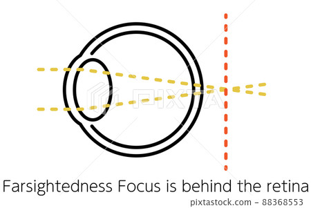 視力和屈光不正、遠視（聚焦在視網膜後面）的醫學插圖 88368553