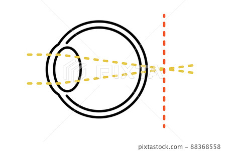 Medical illustration of visual acuity and refractive error, hyperopia (focused behind the retina) Medical illustration of visual acuity and refractive error, hyperopia (focused behind the retina) 88368558