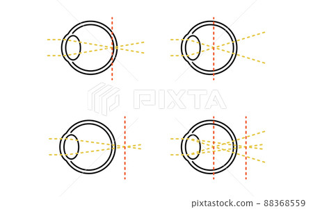 Medical illustrations of visual acuity and refractive error, emmetropia, myopia, hyperopia, astigmatism Medical illustrations of visual acuity and refractive error, emmetropia, myopia, hyperopia, astigmatism 88368559