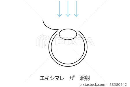 LASIK, Medical Illustration of Refractive Surgery 88380342