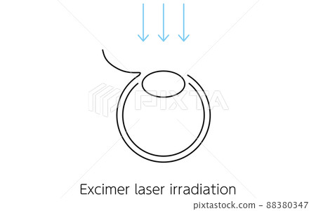 LASIK, Medical Illustration of Refractive Surgery - Stock Illustration ...