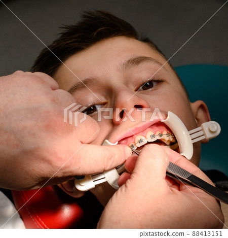 An orthodontist glues and fastens braces on the upper teeth of a schoolboy, aligning teeth with braces. An orthodontist glues and fastens braces on the upper teeth of a schoolboy, aligning teeth with braces. 88413151