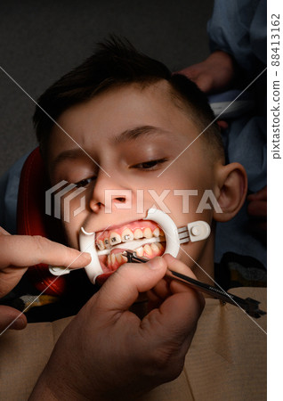 Close up of installing braces on teeth, aligning teeth with braces, retractor on lips. Close up of installing braces on teeth, aligning teeth with braces, retractor on lips. 88413162