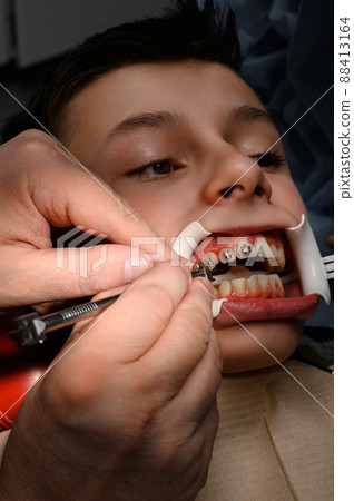 Close up of installing braces on teeth, aligning teeth with braces, retractor on lips. 88413164