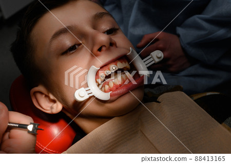 Close up of installing braces on teeth, aligning teeth with braces, retractor on lips. 88413165