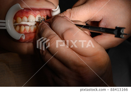 The orthodontist installs braces for the student's boyfriend, visits to the dentist, installation of braces, retractor on the patient's lips. 88413166