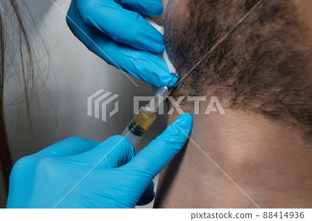 Injection plasma into beard hair man cosmetologist doctor. Injection plasma into beard hair man cosmetologist doctor. 88414936