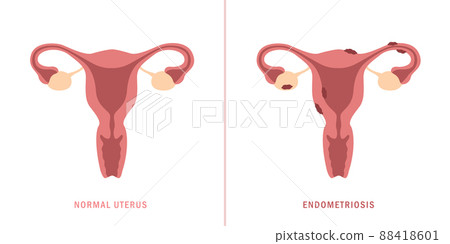 endometriosis and normal uterus womens health anatomy info graphic 88418601