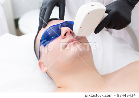 Close-up of the face of a cute young man in blue safety glasses during a laser hair removal procedure on his face Close-up of the face of a cute young man in blue safety glasses during a laser hair removal procedure on his face 88449434