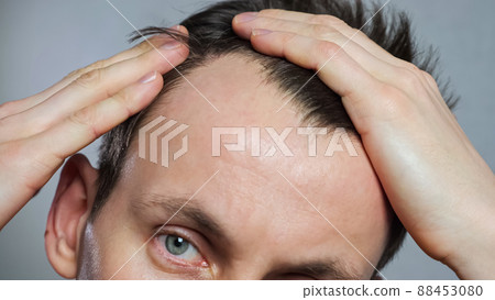 Young man with bald spots suffering from hair loss, Young man with bald spots suffering from hair loss, 88453080